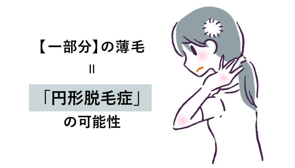 女性の一部分の薄毛は「円形脱毛症」の可能性
