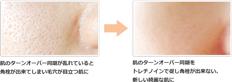 毛穴イメージ