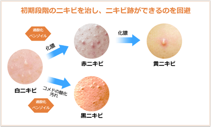 初期段階ニキビイメージ