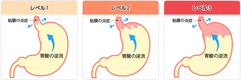 胃酸の逆流イメージ