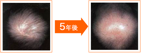 うす毛5年後の画像