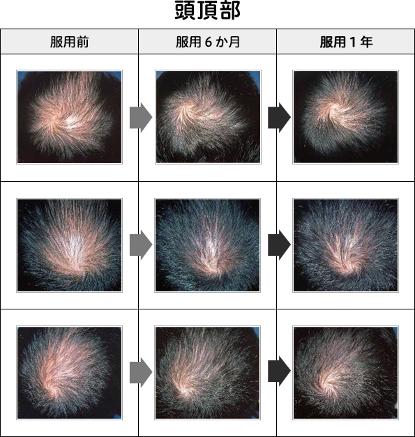 頭頂部変化の画像