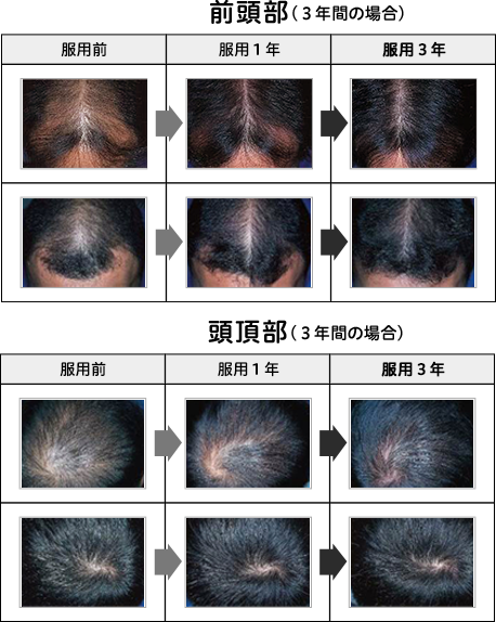 前頭部と頭頂部変化の画像