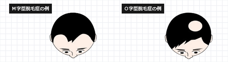 脱毛症の例