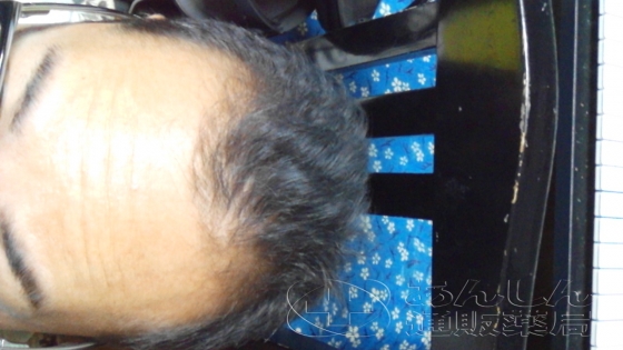 AGA治療薬お得セットの口コミ画像