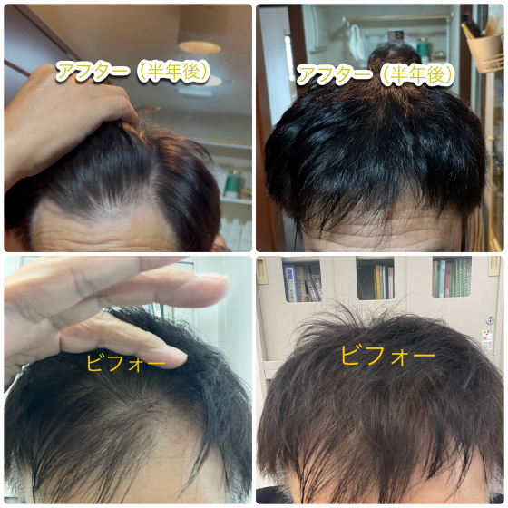 日本語AGA治療薬お買い得セット【2】の口コミ画像